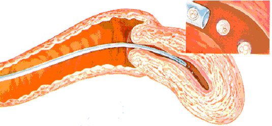 embryo transfer image 2