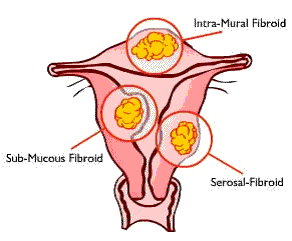 Uterine Fibroids