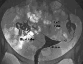 hysterosalpingogram