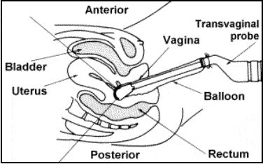 Saline Sonography