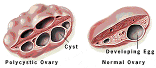 Polycystic Ovary Syndrome